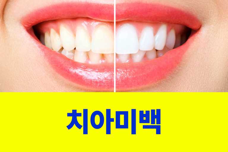 치아미백 시술 지속기간, 오래 유지하는 관리