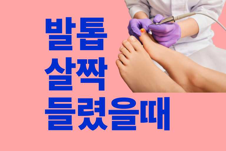 발톱 살짝 들렸을때